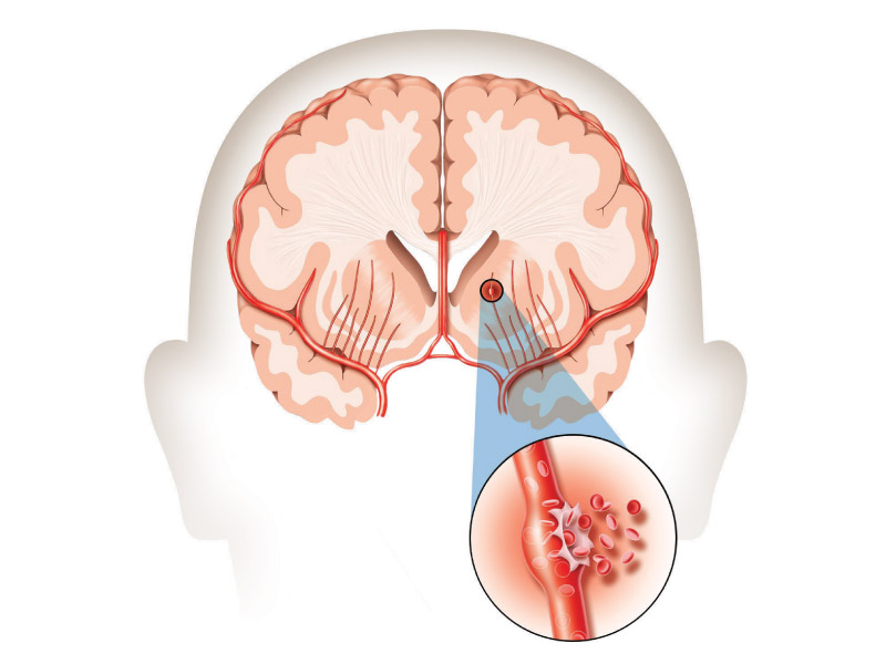 can cigarettes cause strokes Smoking boosts risk for rare, often fatal, bleeding stroke