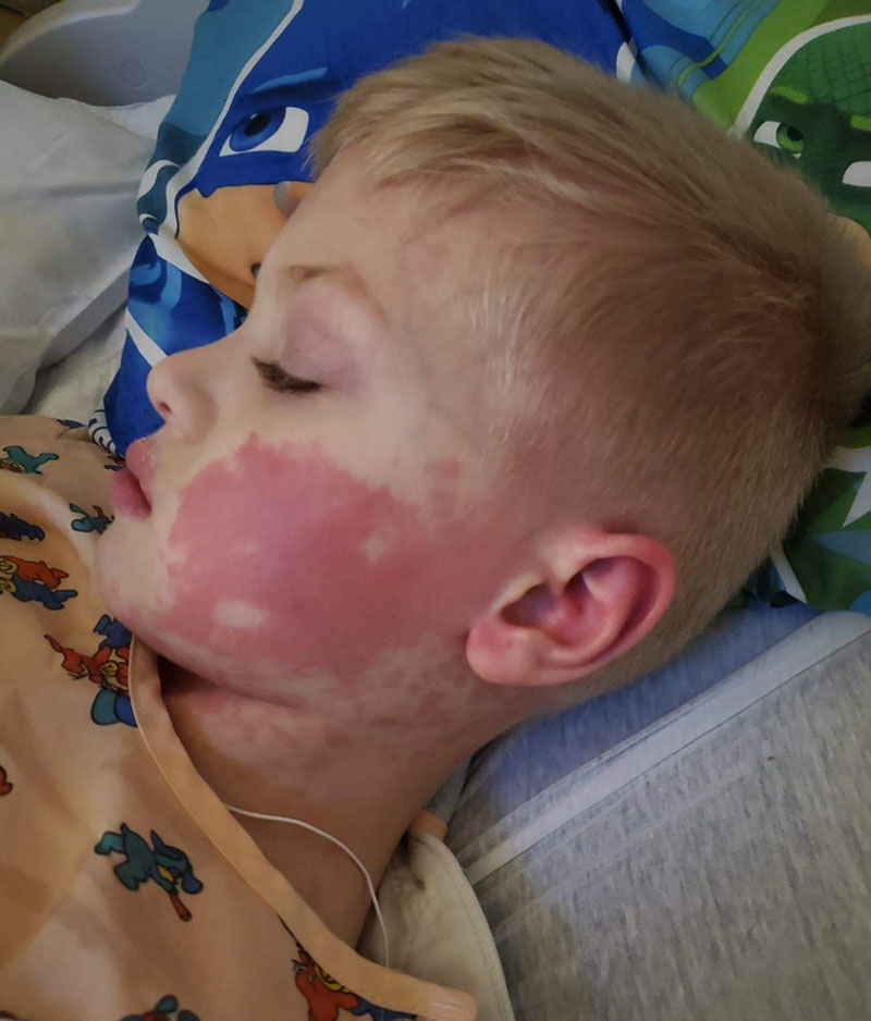 Cameron Dye was covered from head to toe in a rash, which is a common symptom of MIS-C. (Photo courtesy of the Dye family)