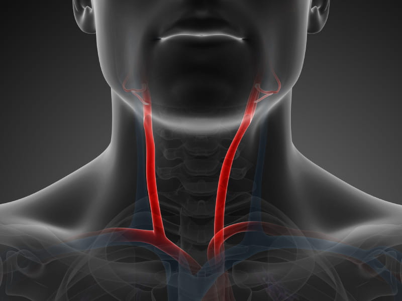 Smartphone video could assist detect narrowed neck arteries that may result in strokes