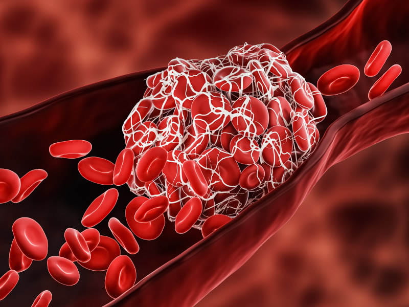 COVID-19 linked to risk of dangerous blood clots stroke patients | American Heart Association