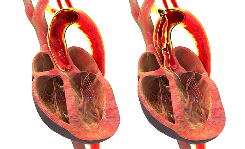 an illustration of a normal aorta (left) and one with aortic dissection, a tear in a layer of the aortic wall that allows blood to flow between the wall layers