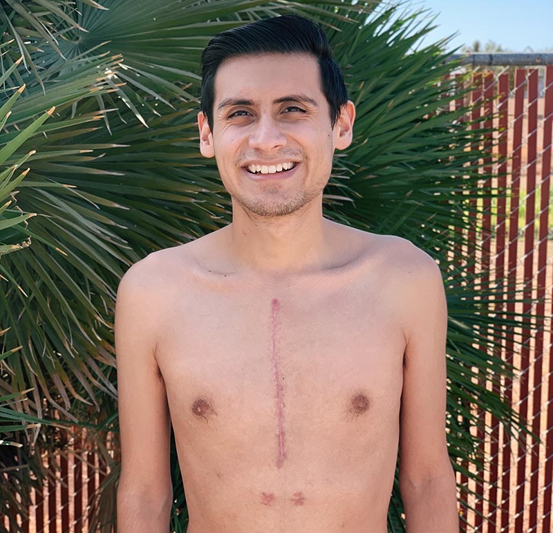 Arthur Castro shows off the scar from his open heart surgery in August 2020 during the pandemic. (Photo courtesy of Arthur Castro)
