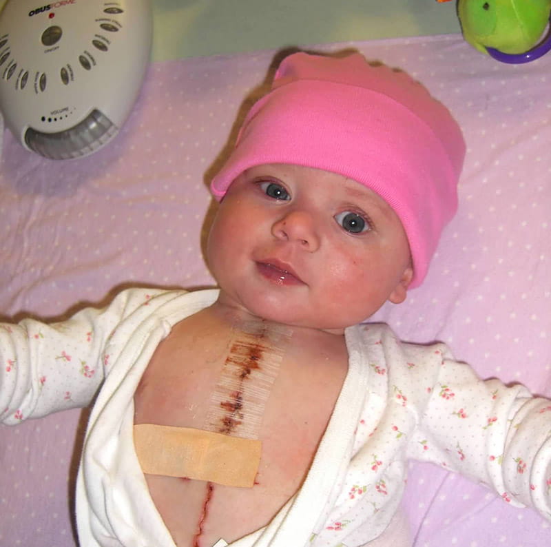 Peyton Bono after her first open-heart surgery in 2006. (Photo courtesy of the Bono family)