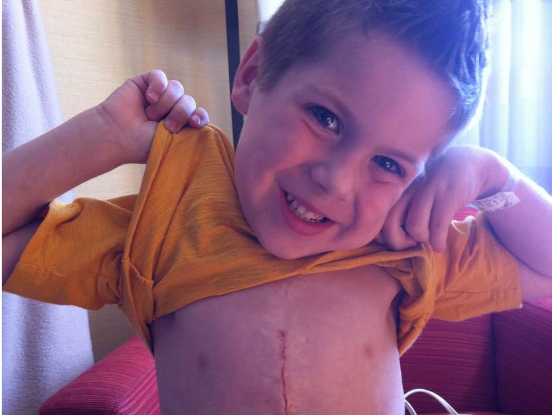 Gavin Kuykendall showing his heart surgery scar.
