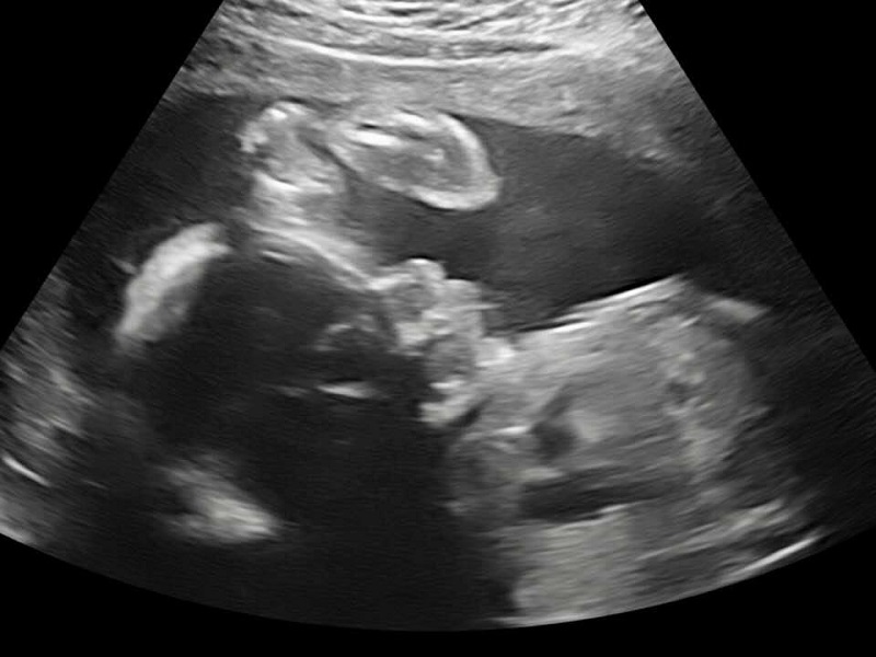 Ultrasound of Lorenzo Catanese, who had several major heart defects.