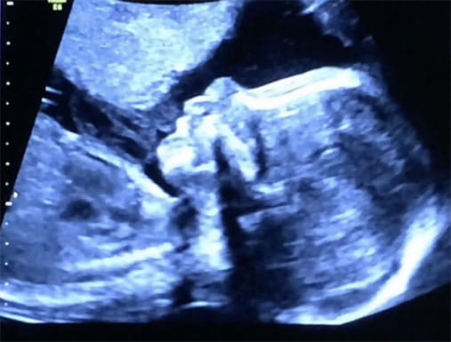 Finn, heart disease survivor in utero