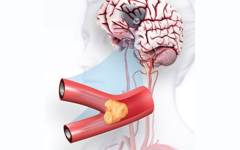 Illustration of a brain blockage