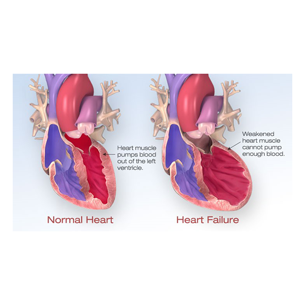 Normal Heart, heart muscle pumps blood out of the left ventricle. Heart Failure: weakened heart muscle cannot pump enough blood.