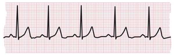 tachycardia meaning in english