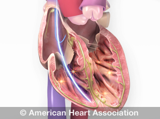 Pacemaker Icd Device : Overview Of Pacemakers And Implantable Cardioverter Defibrillators Icds / Ecg, function, troubleshooting and this section is devoted to artificial pacemakers.