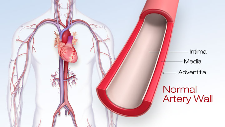 Atherosclerosis American Heart Association