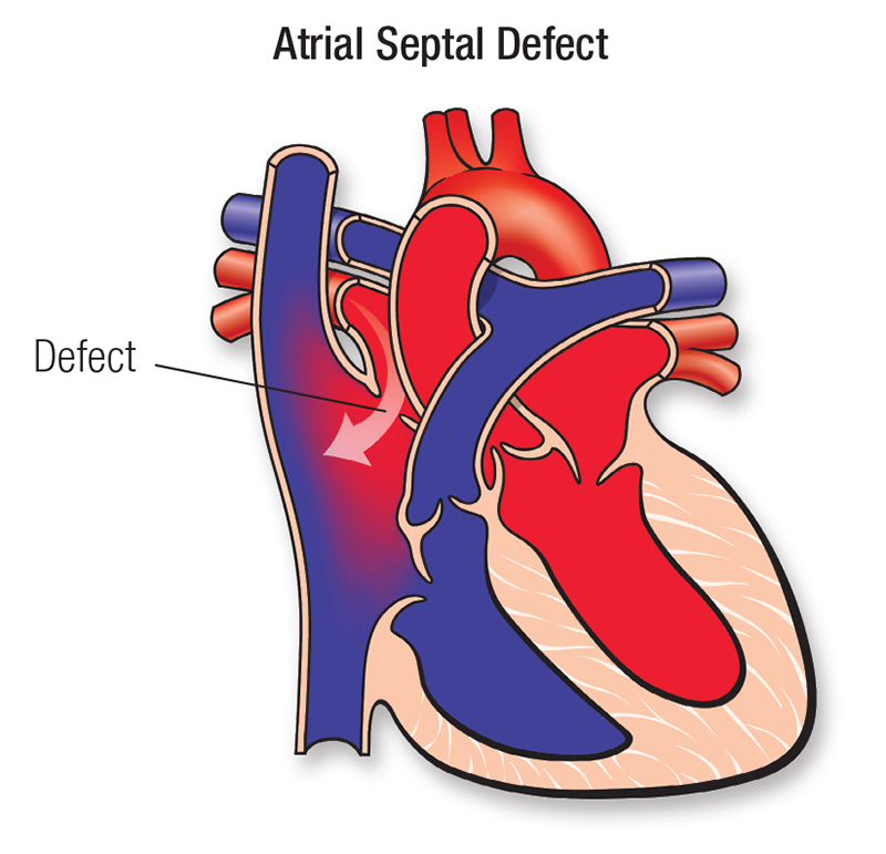 Pathophysiology Of Atrial Septal Defect In Flow Chart