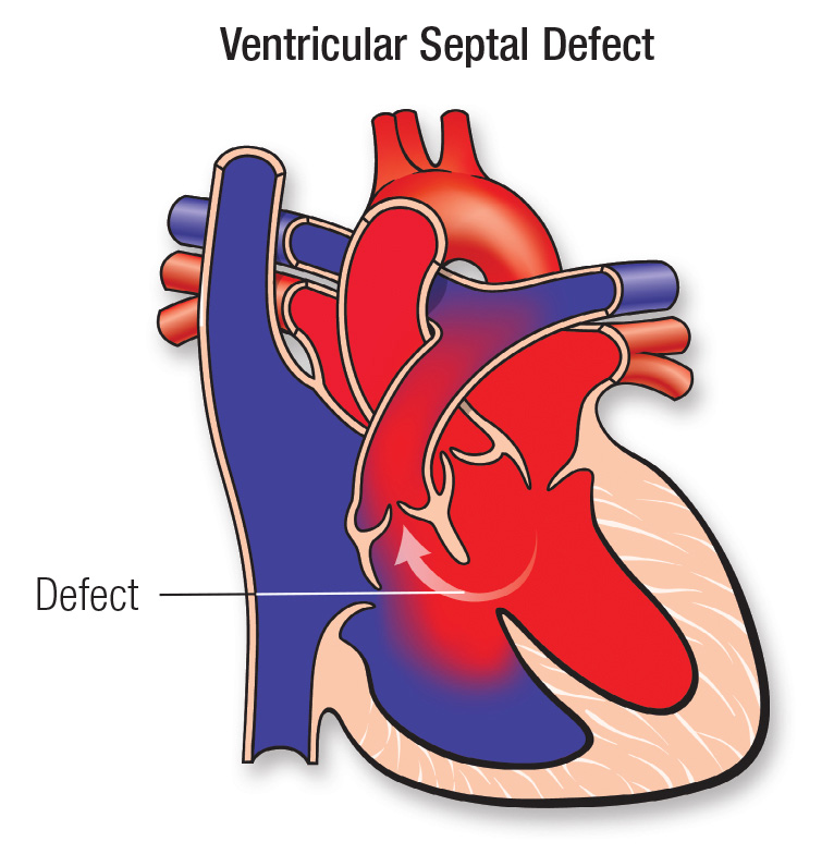 Pathophysiology Of Ventricular Septal Defect In Flow Chart