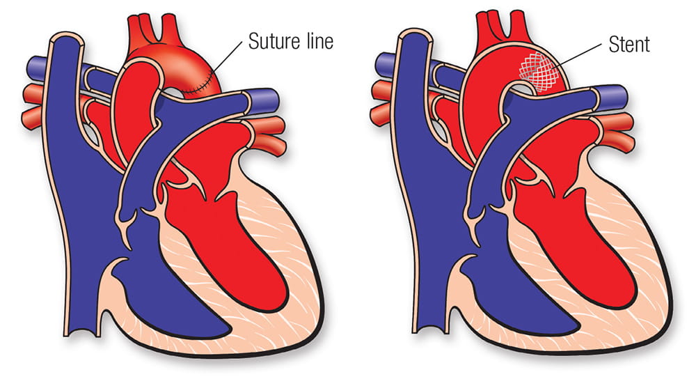 Coarctation of the Aorta (CoA) American Heart Association
