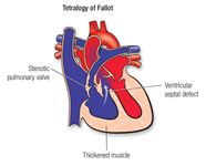 Tetralogy Of Fallot American Heart Association