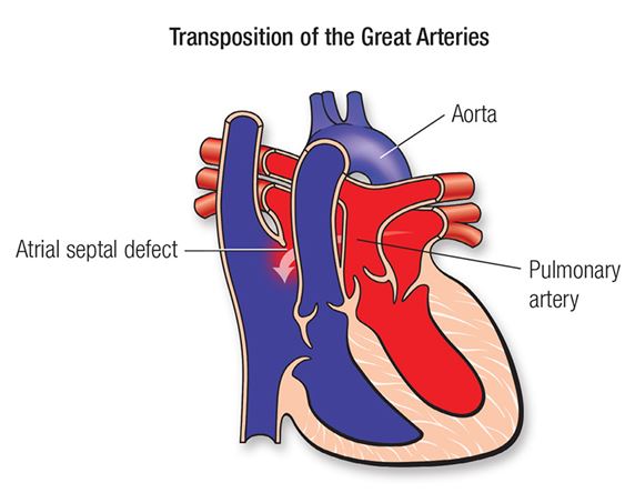 d transposition of the great arteries american heart association