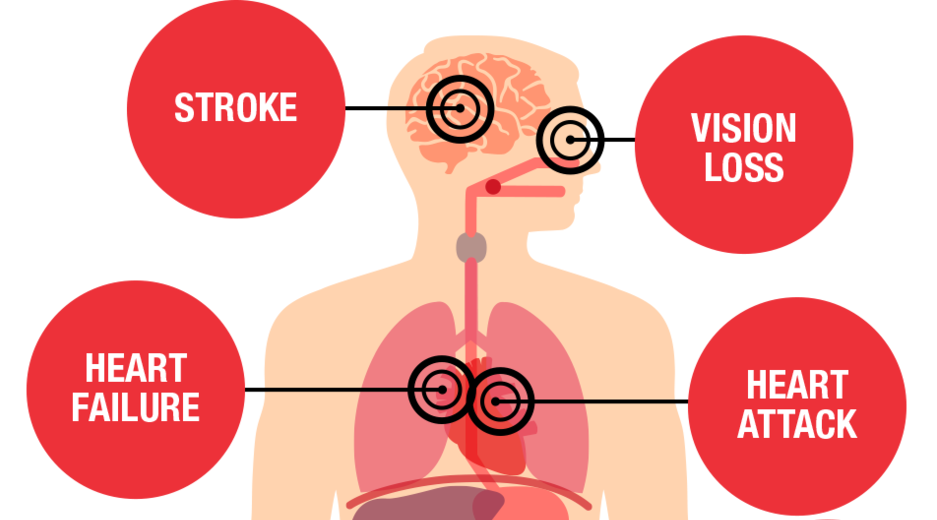 Heart And Stroke Blood Pressure Chart