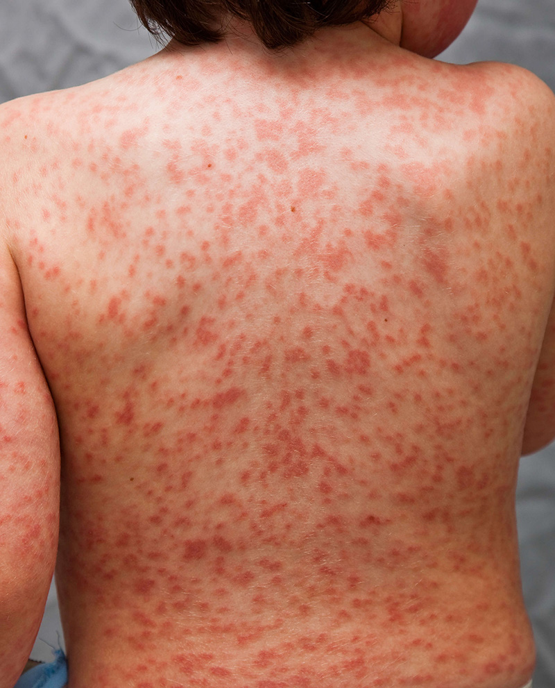 Kawasaki Disease Diagnosis Kawasaki Disease Diagnosis
