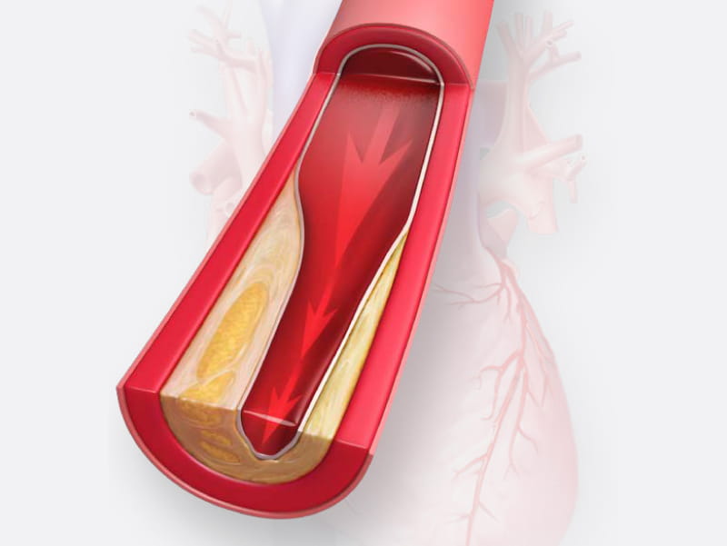 Coronary calcium test could help clarify heart disease risk and