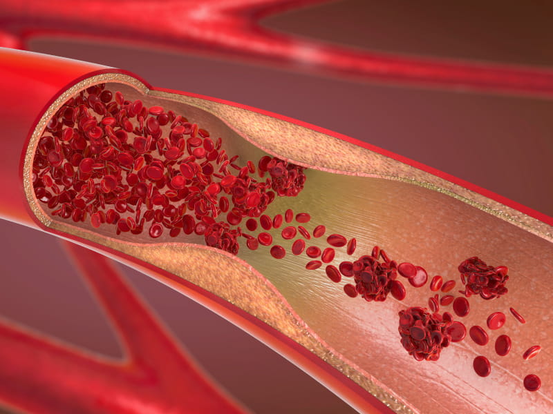 Diets low in cholesterol can help reduce heart disease, stroke risk |  American Heart Association