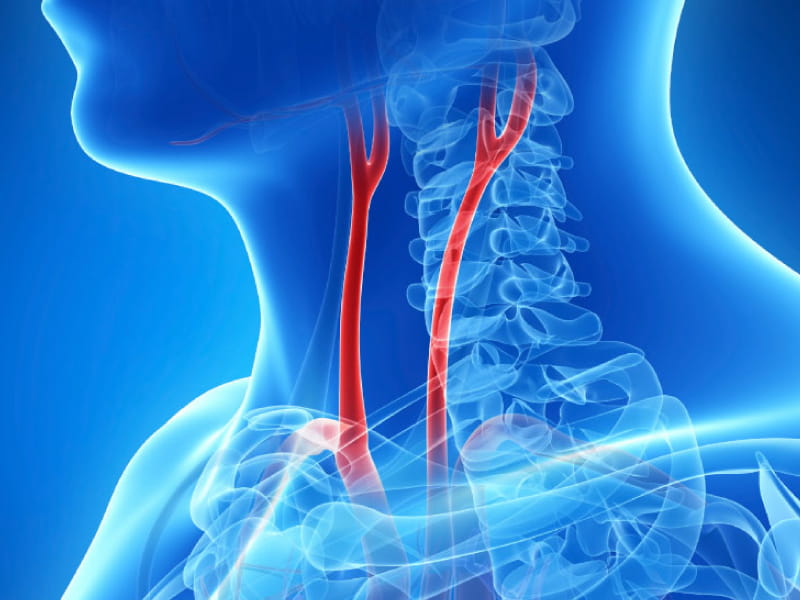 Treatment to Ward Off Stroke Less Effective in Women: AHA News Treatment to Ward Off Stroke Less Effective in Women: AHA News