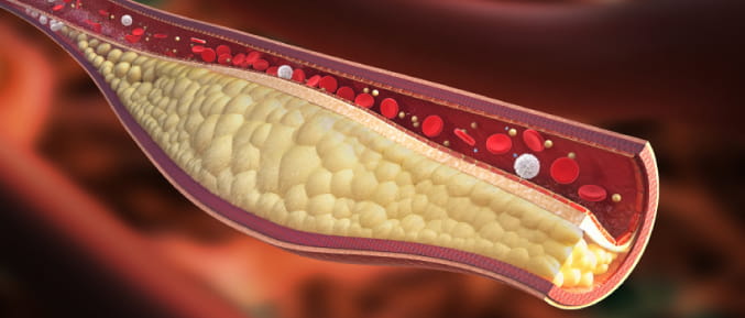 High cholesterol during young adulthood raises heart disease risk | American Heart Association