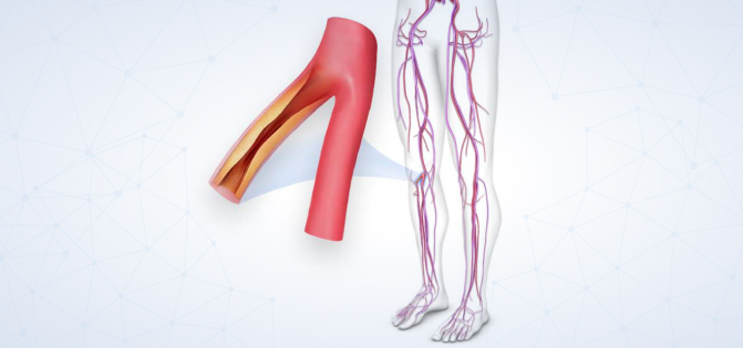 vascular disease illustration