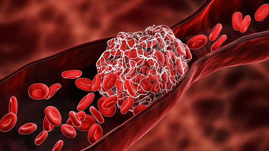 A close-up illustration of a blood clot