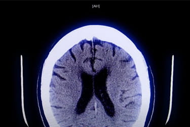 Marcella's Story - Mission: Lifeline Stroke South Dakota