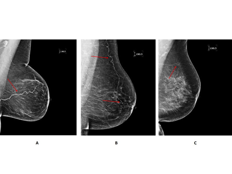 Examples of mammograms showing breast arterial calcification. (Photo courtesy Circulation: Cardiovascular Imaging)