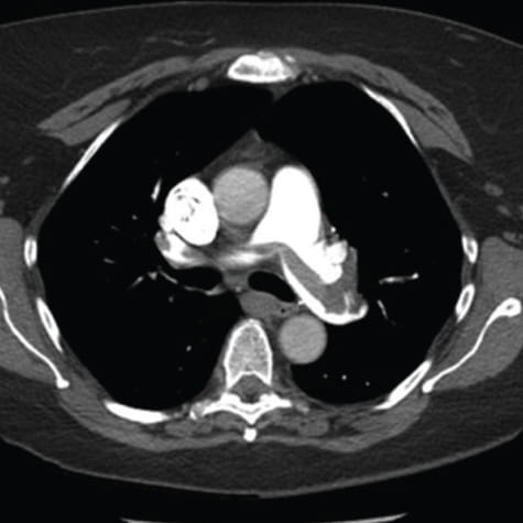 pulmonary embolism photo