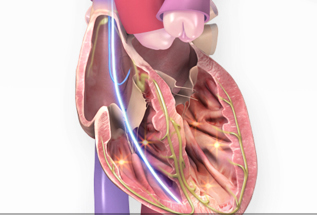 Implantable Cardioverter Defibrillator (ICD) | American Heart Association